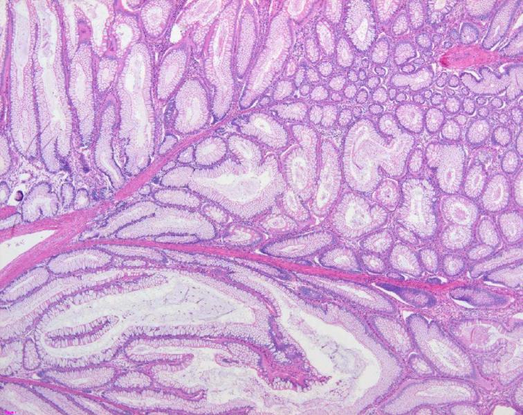 Colon_histology_with_Peutz-Jeghers_polyp