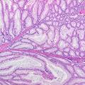 Colon_histology_with_Peutz-Jeghers_polyp