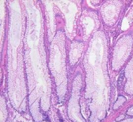 Colon_histology_with_Peutz-Jeghers_polyp